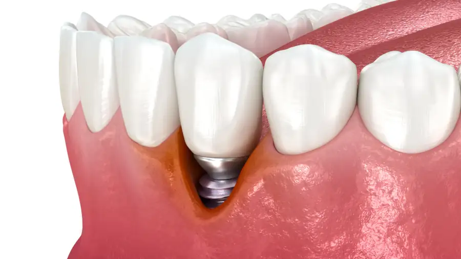 Periimplantitis Implantat Entzundung