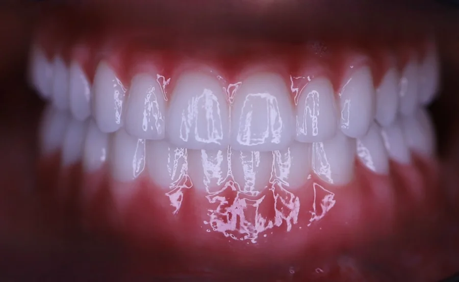 All on 4 / 6 vorher nachher Bilder