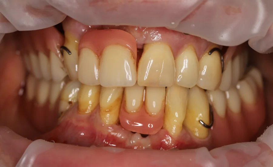 All on 4 / 6 vorher Bilder