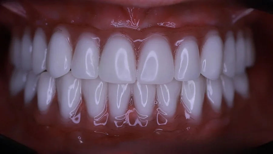 All-on-4 vorher nachher Bilder