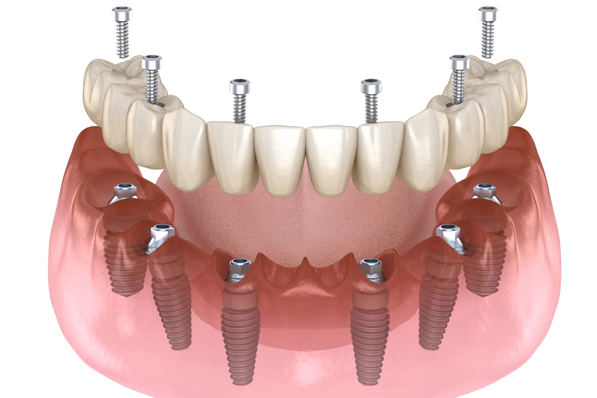 Feste Zähne an einem Tag