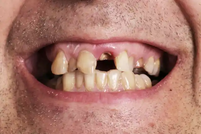 Hässliche Zähne: Ursachen, Folgen & moderne Behandlungen