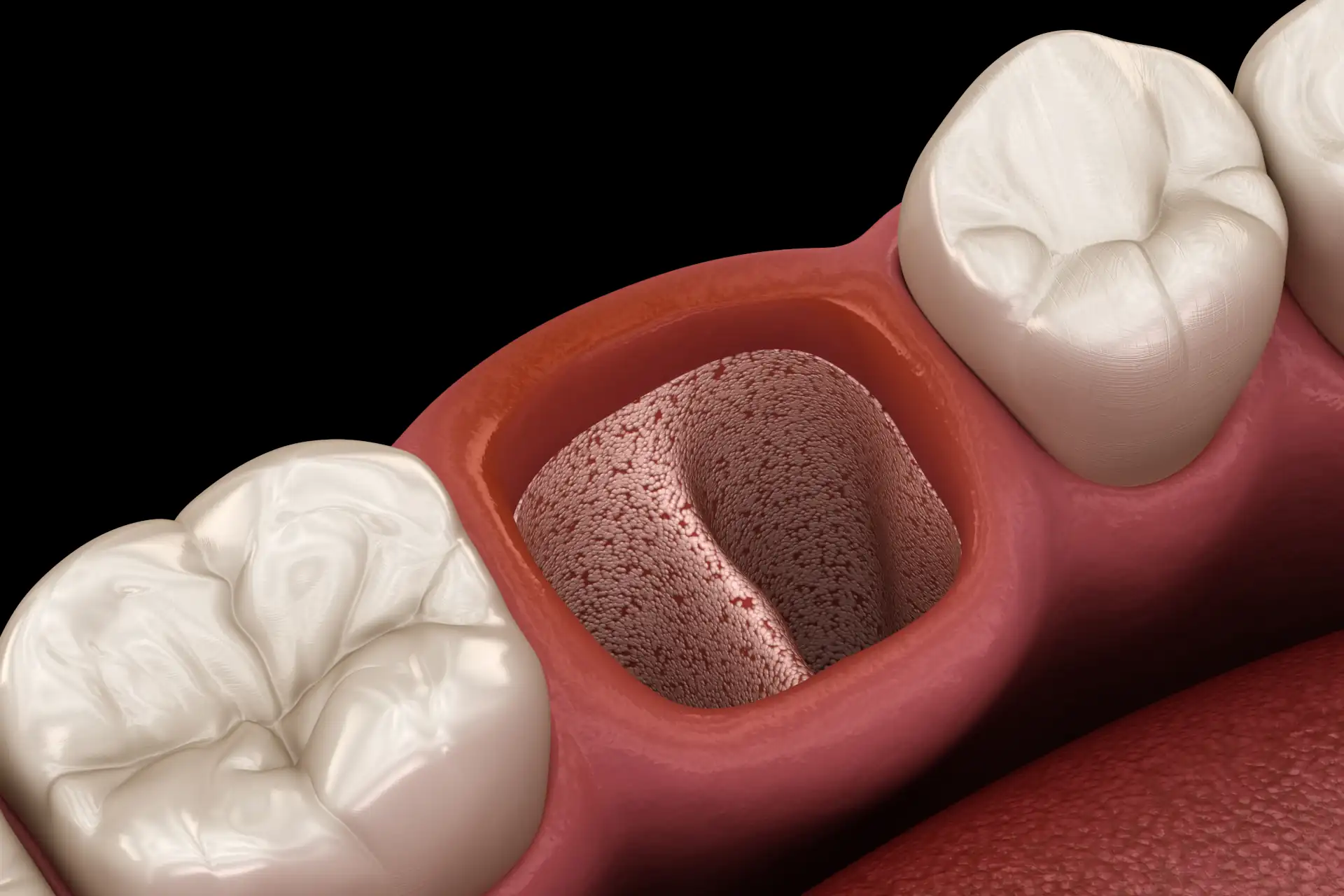 Trockene Alveole Zahn