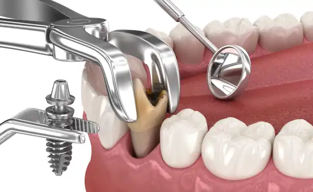 Sofortimplantat: Ablauf, Kosten, Vor- & Nachteile – Neue Zähne an einem Tag