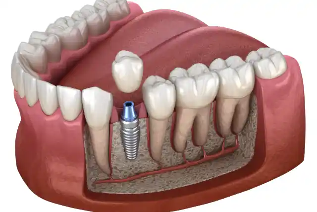 Implantat Zahn: Kosten, Ablauf, Vor- & Nachteile im Überblick