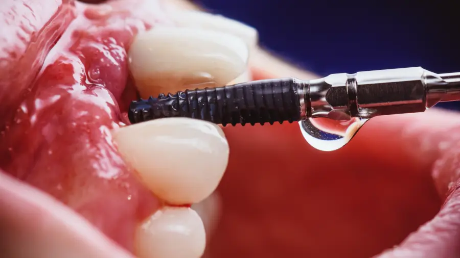 Zahn Implantat Ablauf