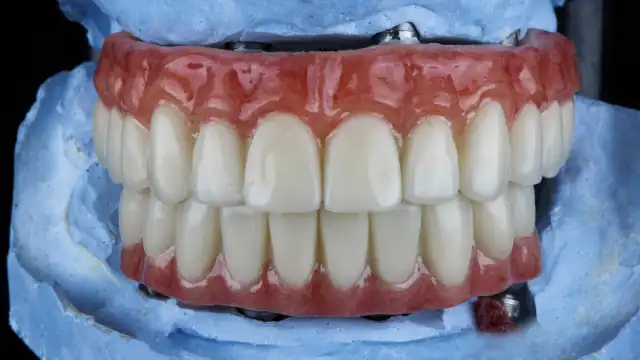 Druckknopfprothese (Locator-Prothese): Kosten, Vor- & Nachteile, Ablauf