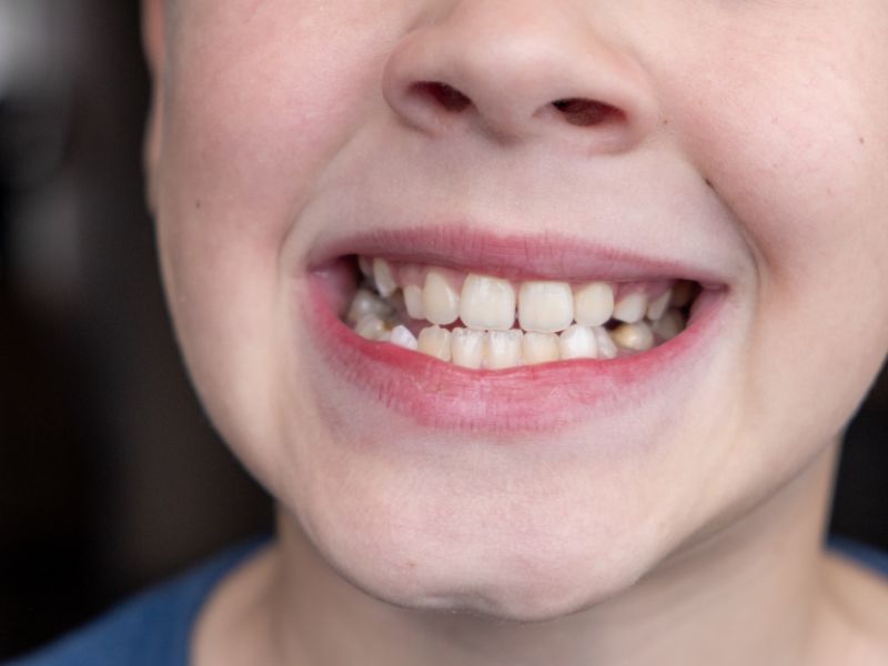Close-up of a child's crowded front teeth before orthodontic treatment