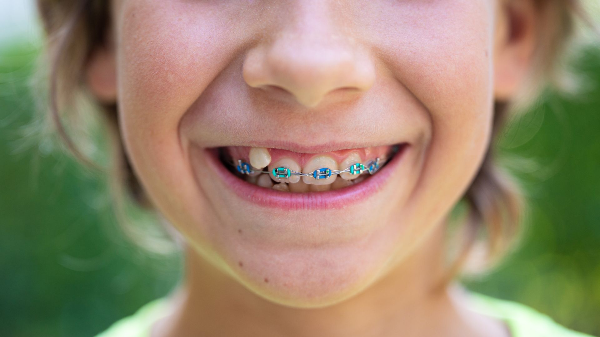 Close-up of a child's smile with braces at Ortho 99 Plus 1, a children's orthodontics practice in Jacksonville, FL