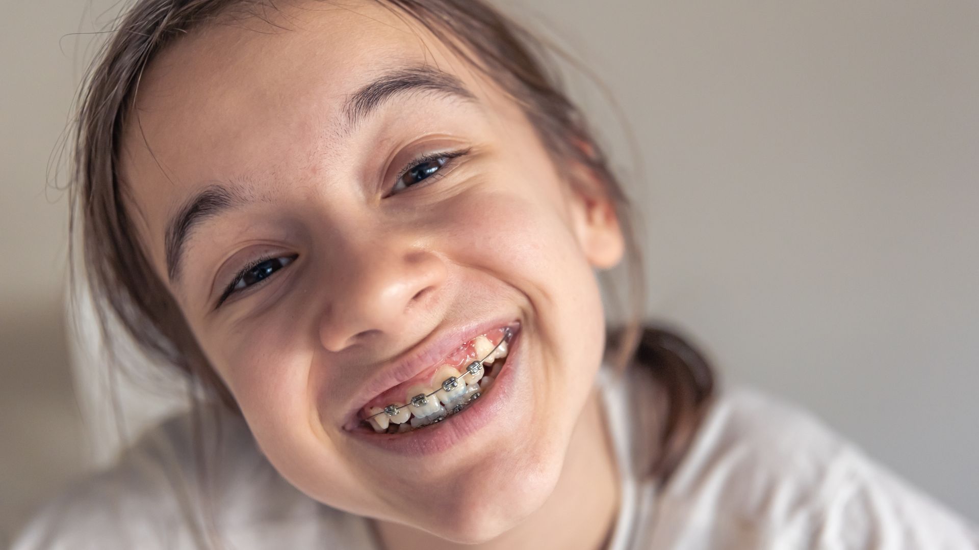 young girl smiling with metal braces in Jacksonville FL