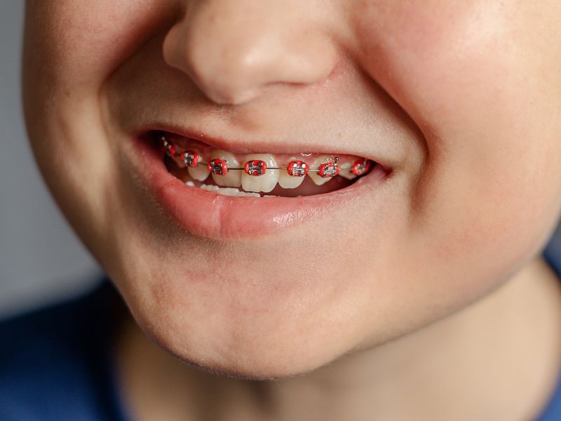 boy smiling with red metal braces in Jacksonville FL