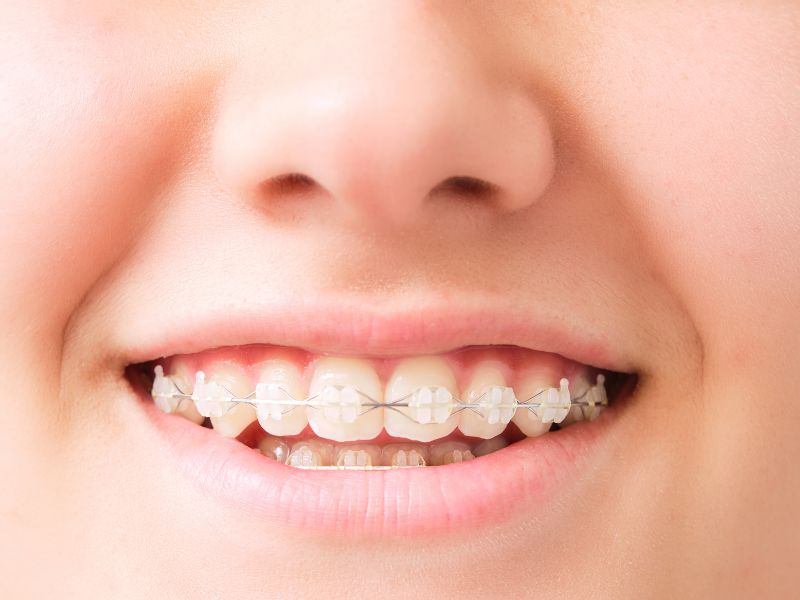 ceramic braces on child's teeth in Jacksonville FL