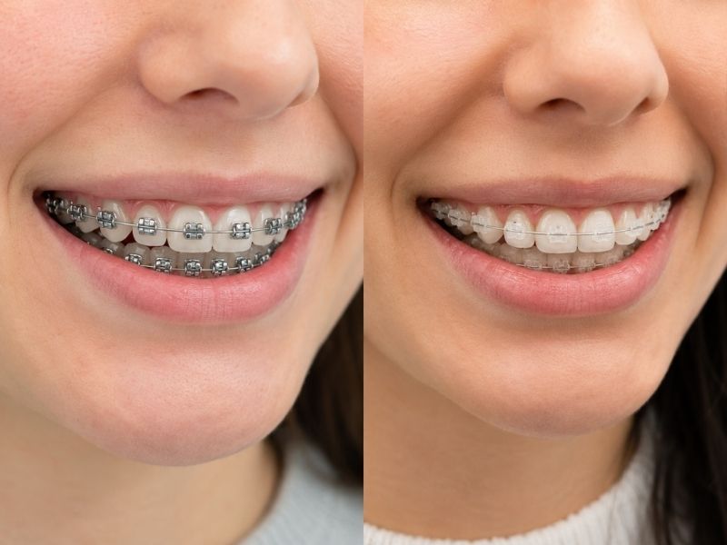 Side-by-side close-up comparing traditional metal braces with tooth-colored ceramic braces