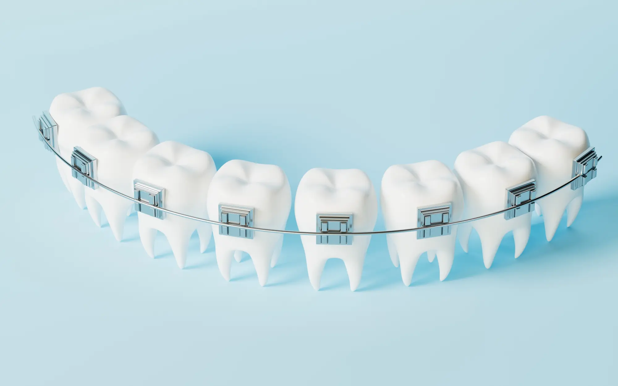 Metal Braces in Woodstock, GA | Sweet Peach Orthodontics