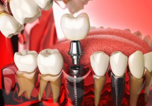 dental implants Rockville