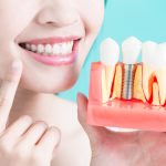 dental implants maryland