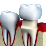 dental crowns maryland