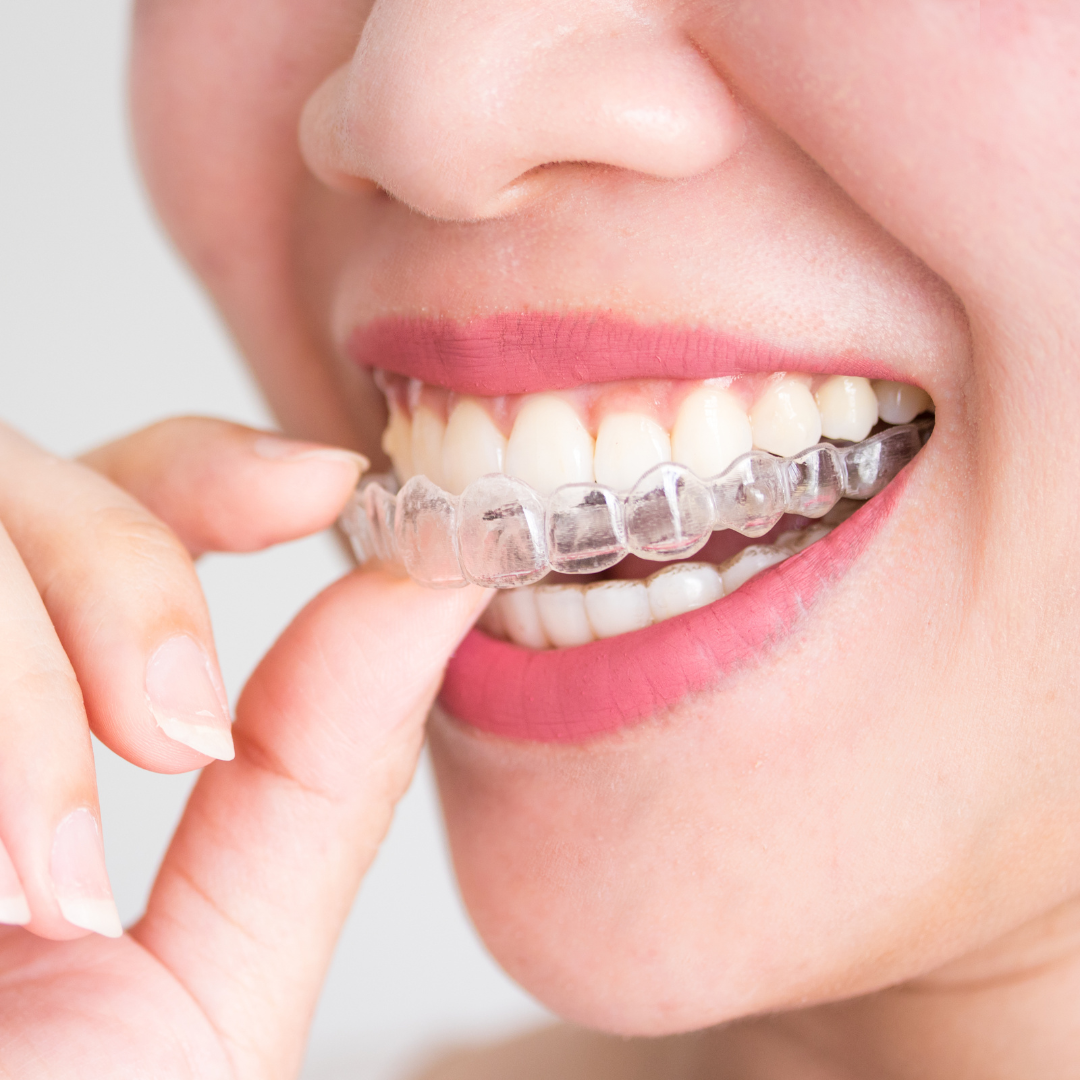 invisalign rockville maryland