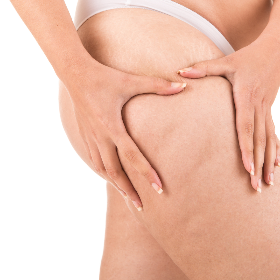 cellulite reduction rockville maryland