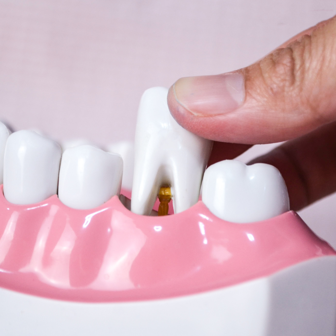 Tooth Extraction Rockville