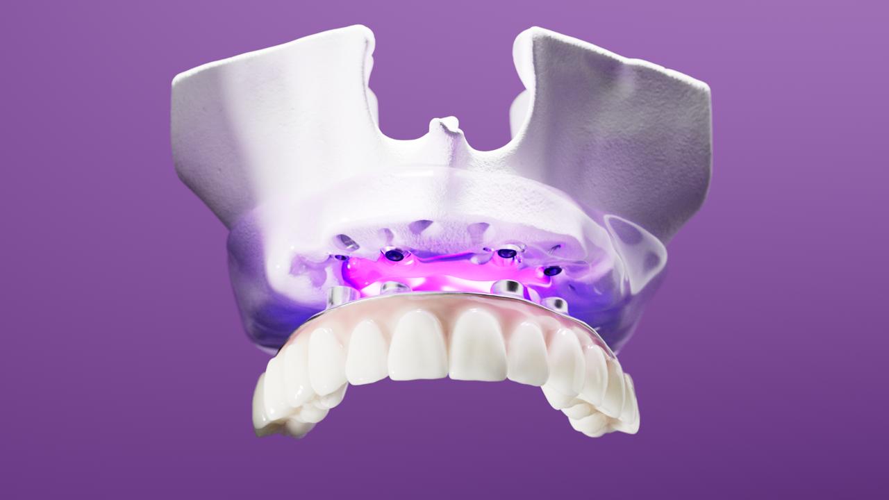 From Dentures to Dental Implants: What To Know