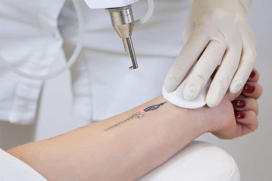 tattoo removal laser treatment