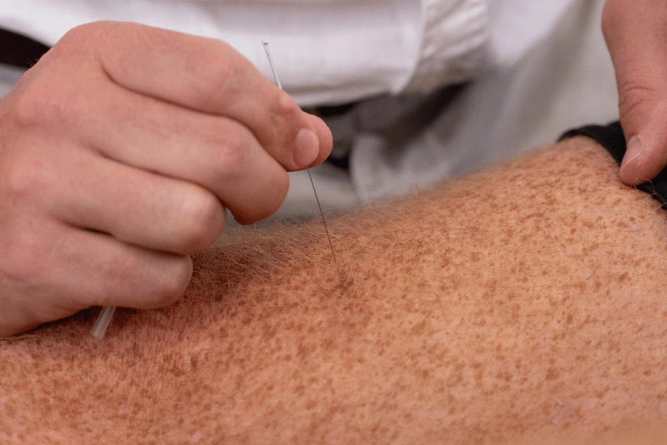 As one of the most well-known therapies in Traditional Chinese Medicine (TCM), it’s still widely practiced today, with modern variations and applications in healthcare.