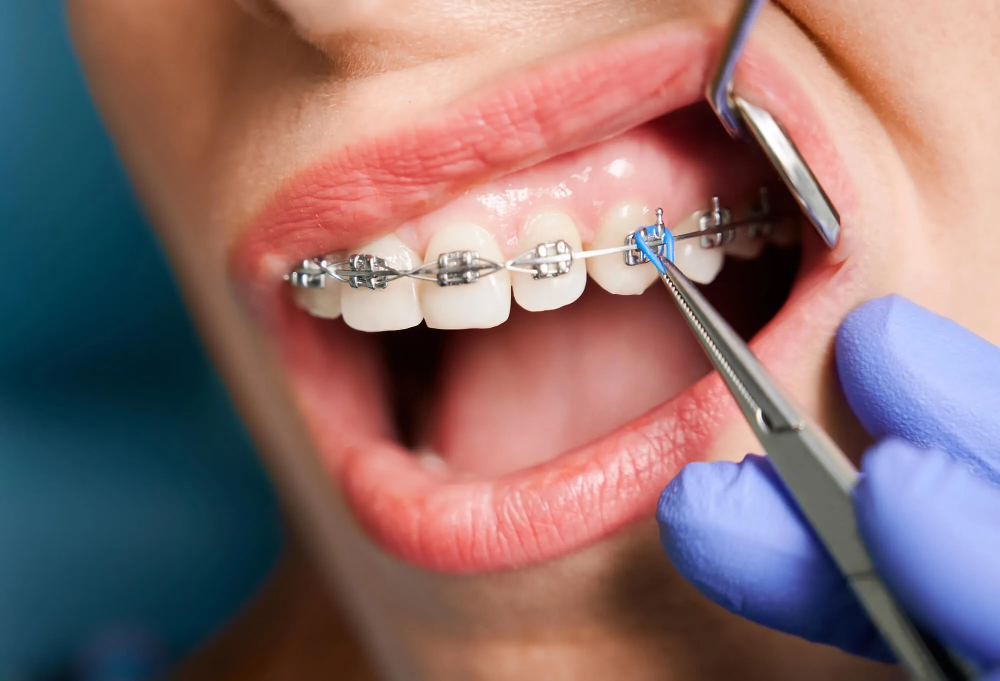 orthodontist checks metal braces birmingham