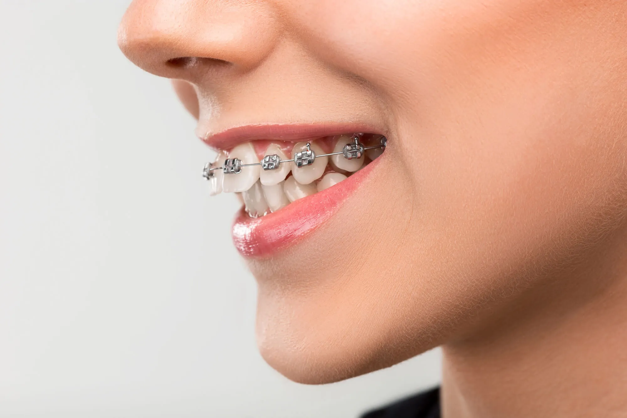 patient wearing metal braces birmingham
