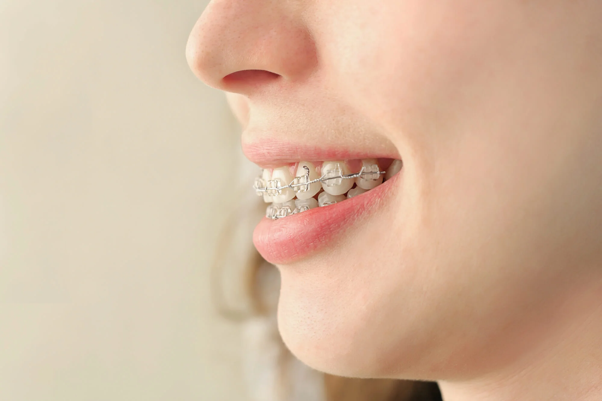 Close-up of ceramic braces smile, Emergency orthodontics in Birmingham, AL