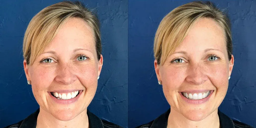 Side-by-side close-up images of a smiling woman with blonde hair and blue eyes against a dark blue background.