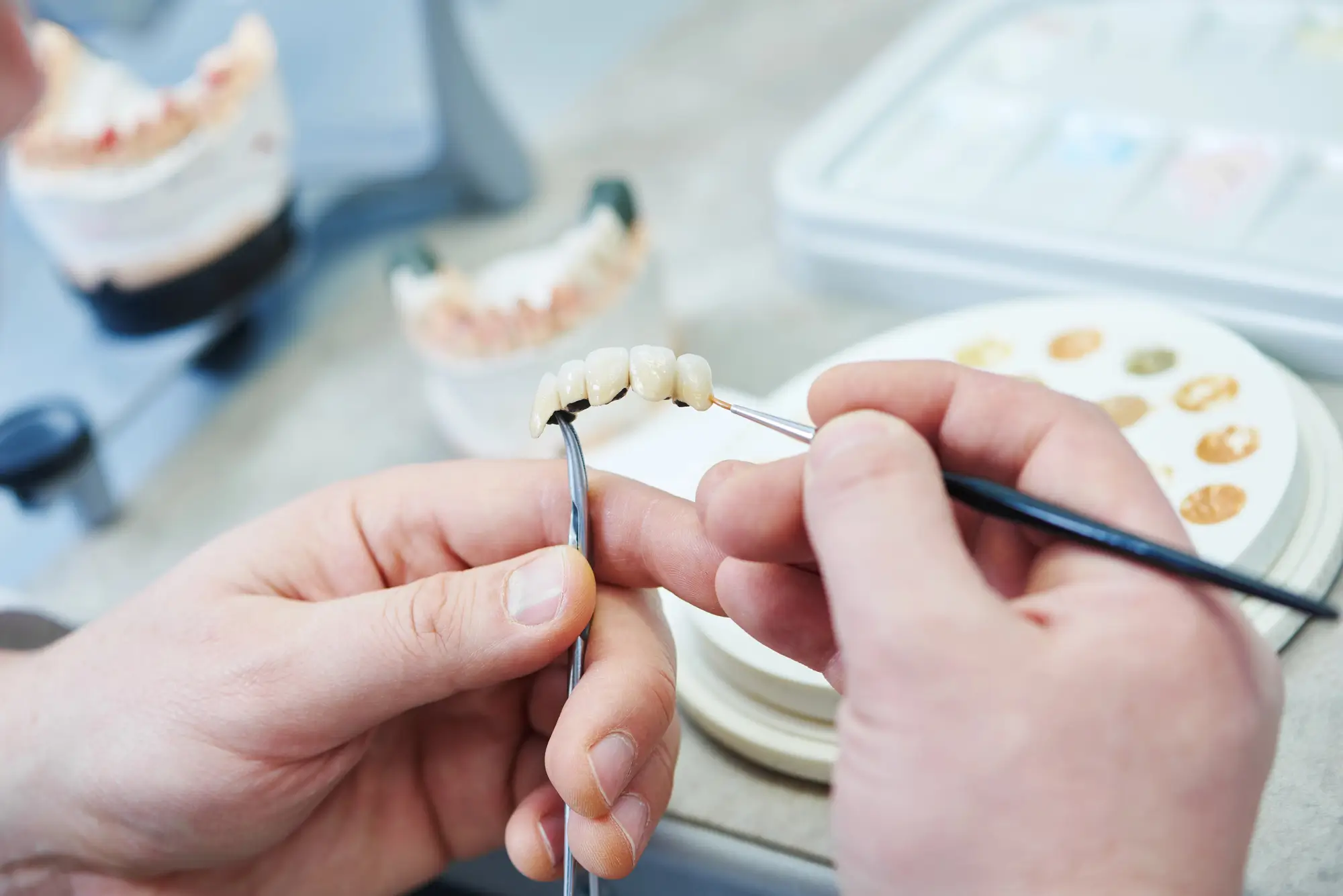 Dental prosthesis work for Dental Bridges Close to Grand Prairie.