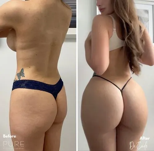 Revolutionizing Beauty Standards with the South Beach Butt Lift: My Personal Journey