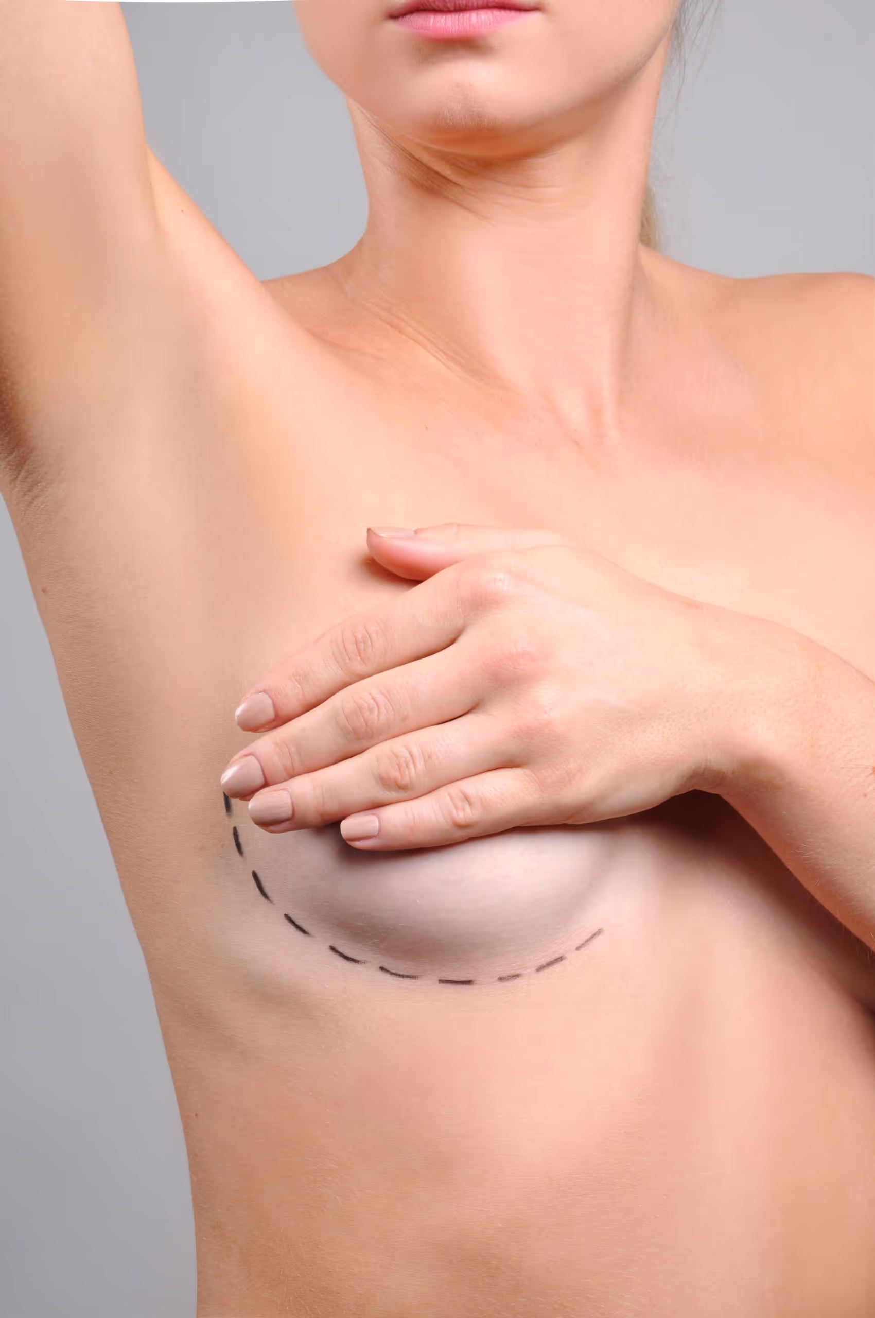 What is a Breast Lift?