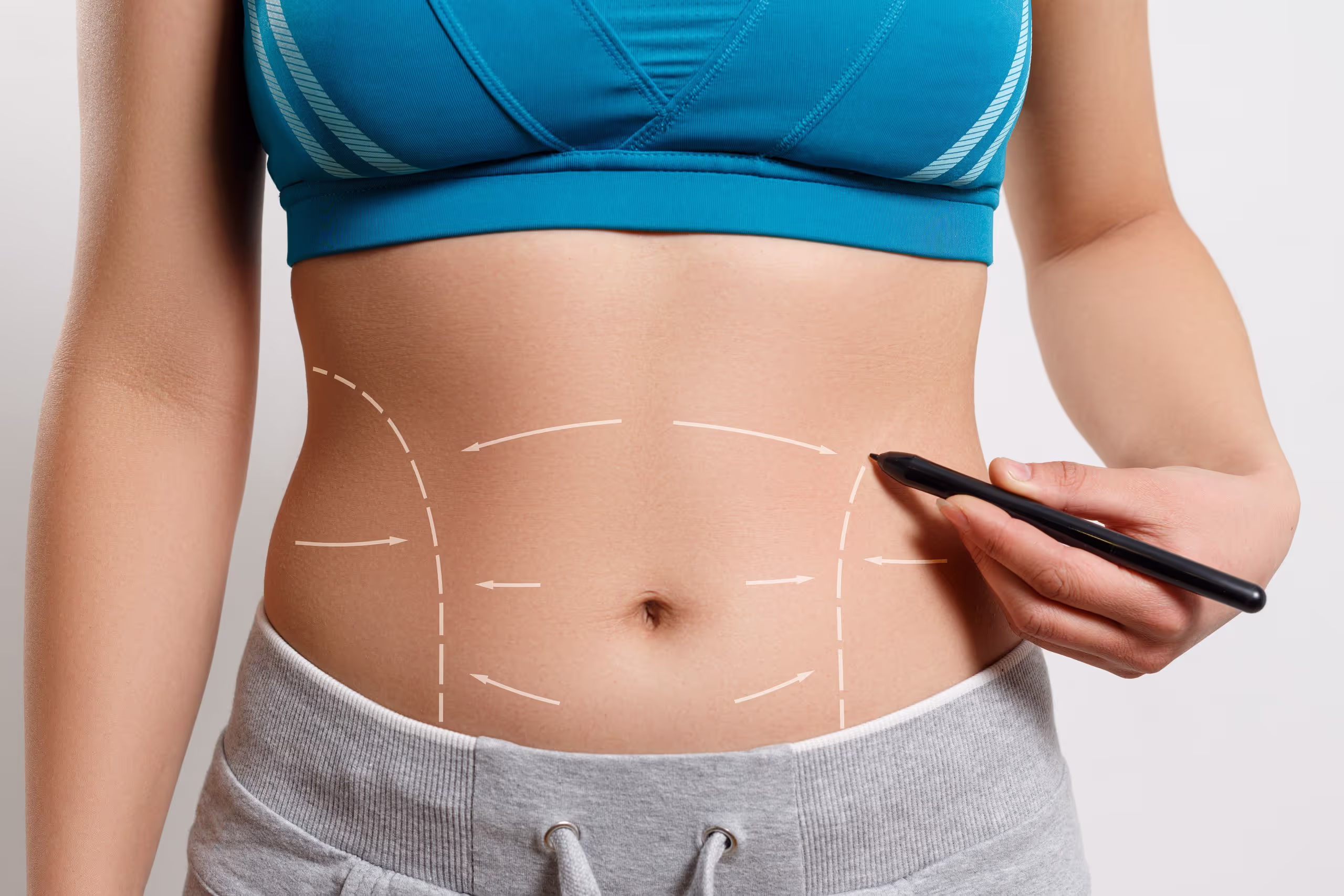 Scars After Tummy Tuck