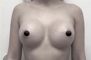 Breast Augmentation Miami