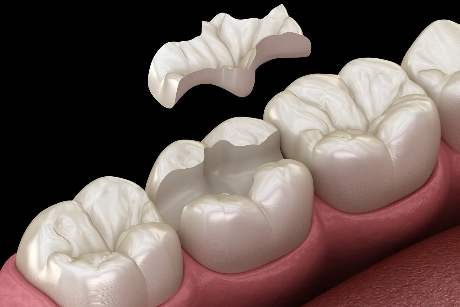 Dental Inlays & Onlays in Orange | Agape Smile Spa