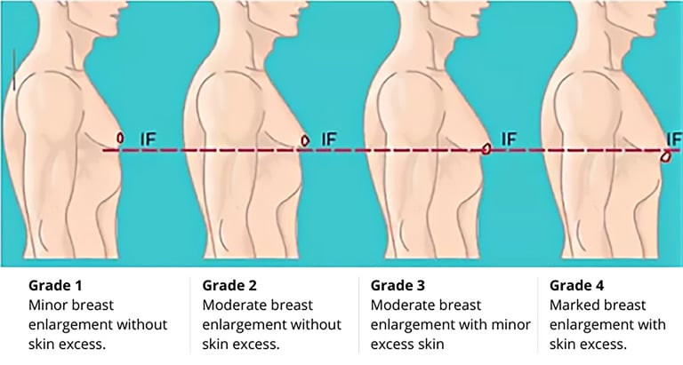 Gynecomastia and Its Treatment Options