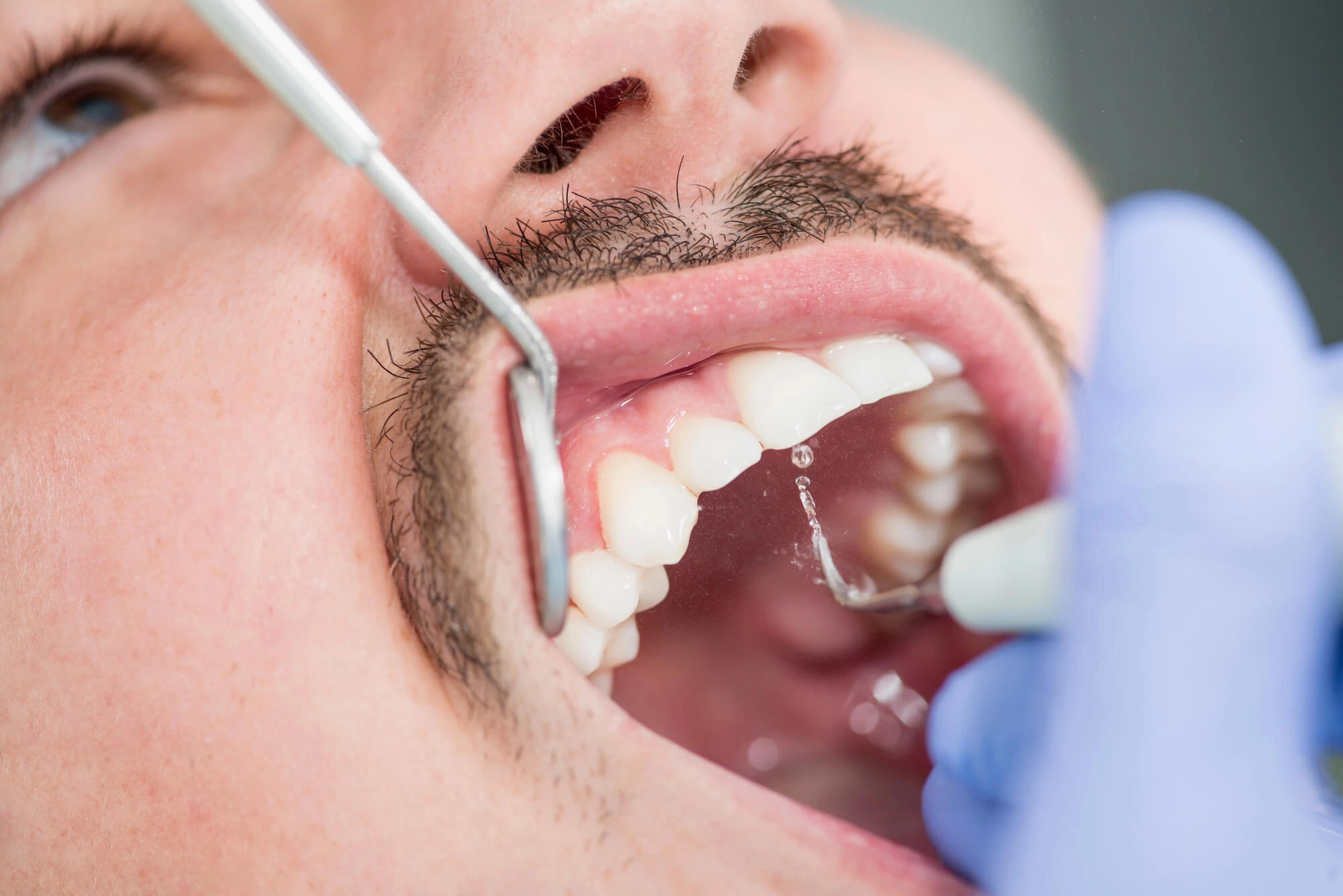 Male Patient Undergoing Deep Teeth Cleaning Procedure for Plaque Removal