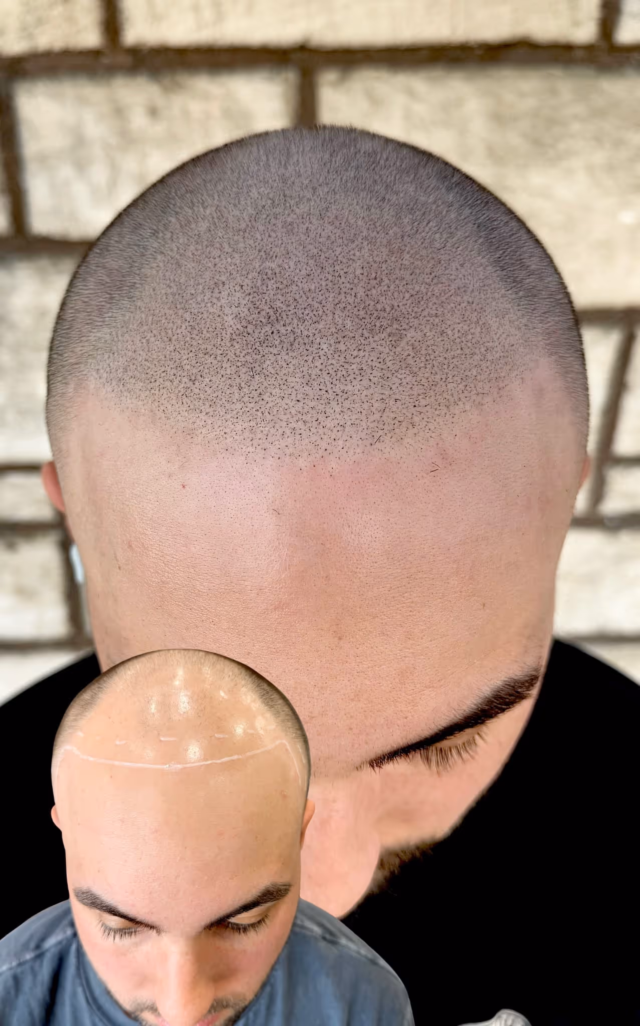 Top-down view of a full scalp micropigmentation hairline