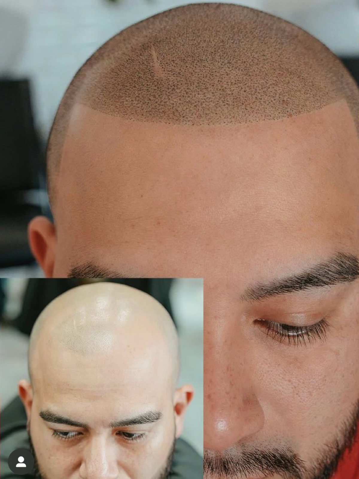 Scalp micropigmentation before and after at Santana & Co in Fort Worth