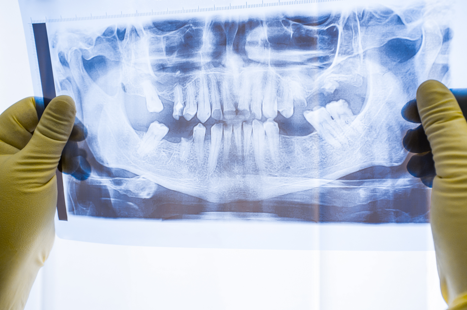Full mouth panoramic in X-ray, showing all the teeth in Wilmington, NC