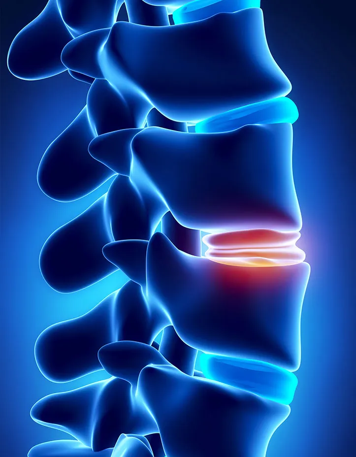 Illustration of a herniated disc in the lumbar spine, showing red color for inflammation.