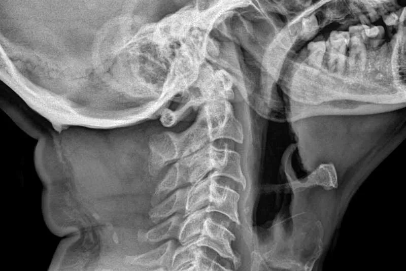 Chiropractic X-ray of the cervical spine - lateral view, showing some disc degeneration and bone spurs.