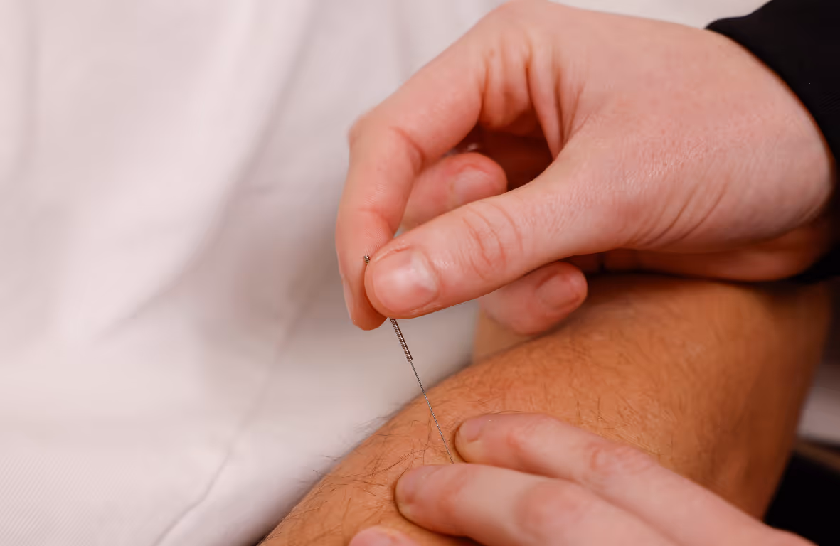 Dry Needling pijnlijk? 7 dingen die je moet weten 