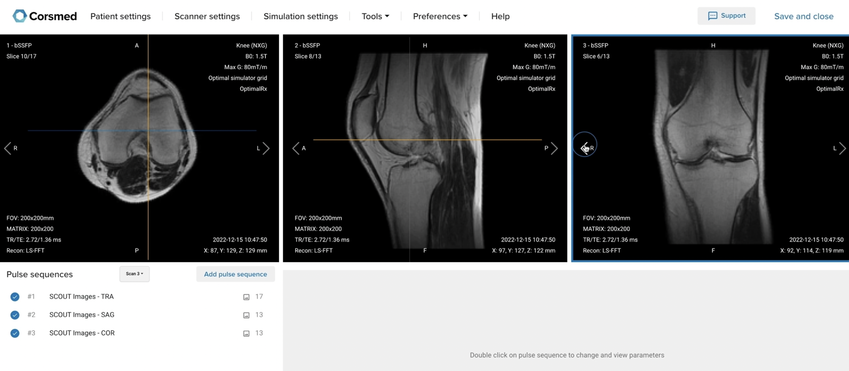 Correct Setup of Localizer Images for Knee MRI Protocol on Corsmed MRI Simulator