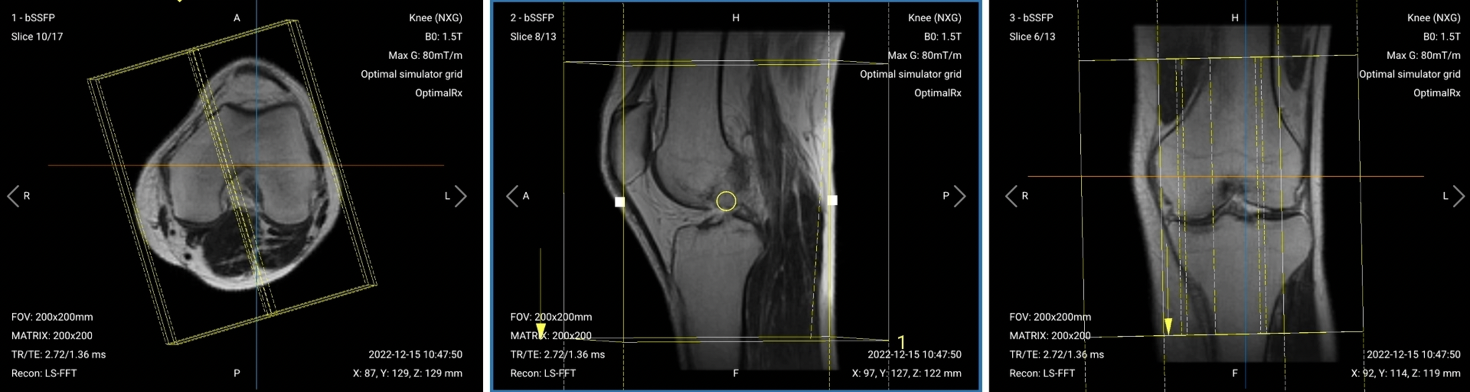 Correct Planning of Sagittal PD FS for knee MRI