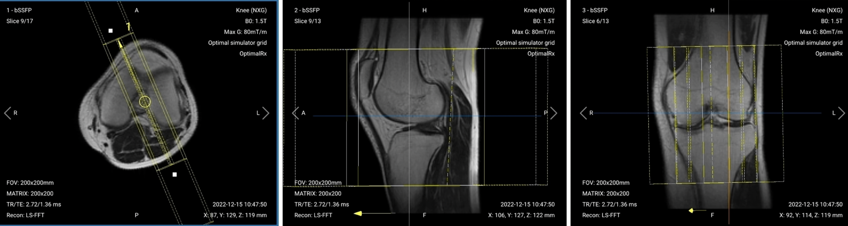 Correct Planning of Sagittal PD FS ACL (Anterior Cruciate Ligament) for knee MRI