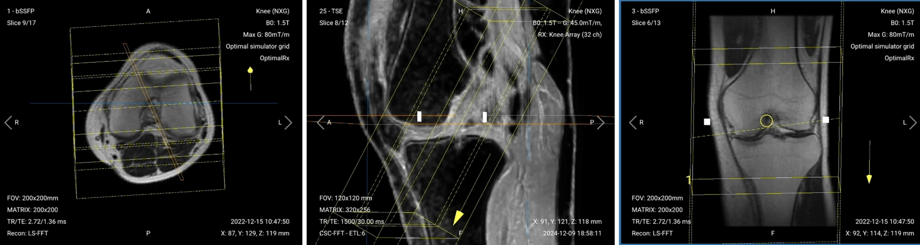 Correct Planning of Coronal PD FS ACL (Anterior Cruciate Ligament) for knee MRI