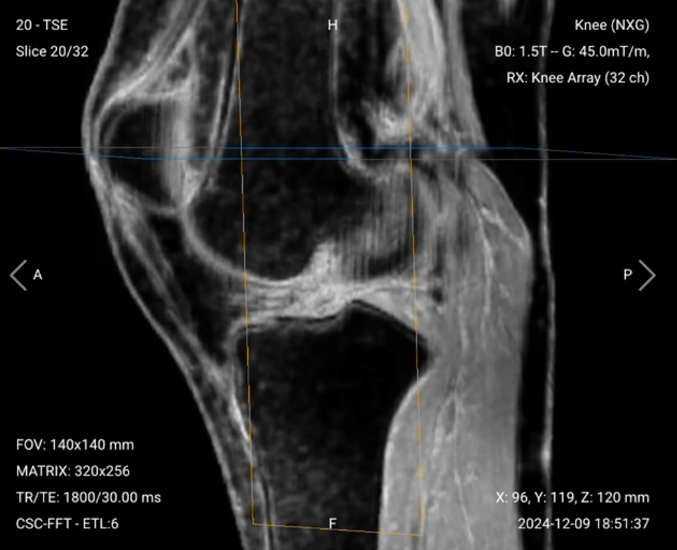 Sagittal PD FS of the Knee – Correct Image